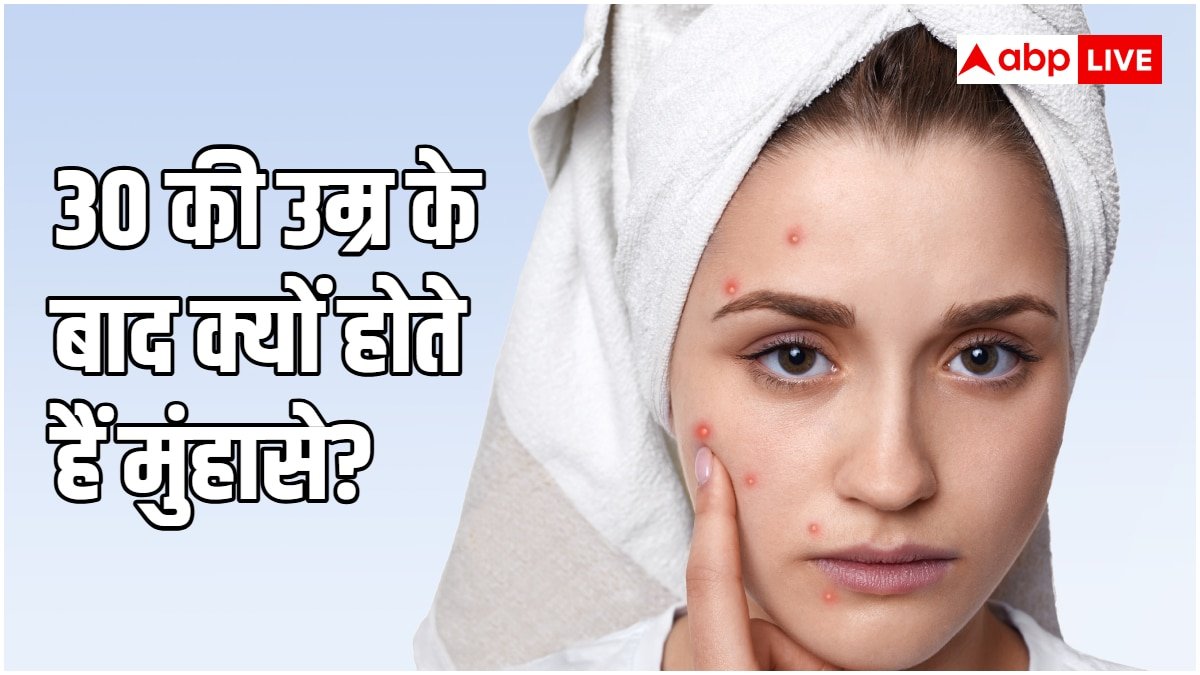30 साल के हो गए हैं फिर भी पीछा नहीं छोड़ रहे मुंहासे? ये हो सकती है वजह