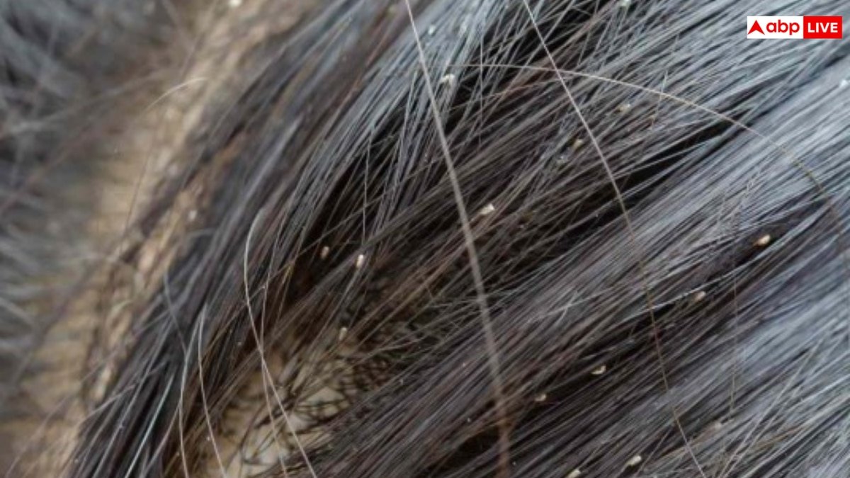 बरसात में बालों में हो गए हैं जुएं? इन नुस्खों से 1 सप्ताह में गायब करें सारी लीख