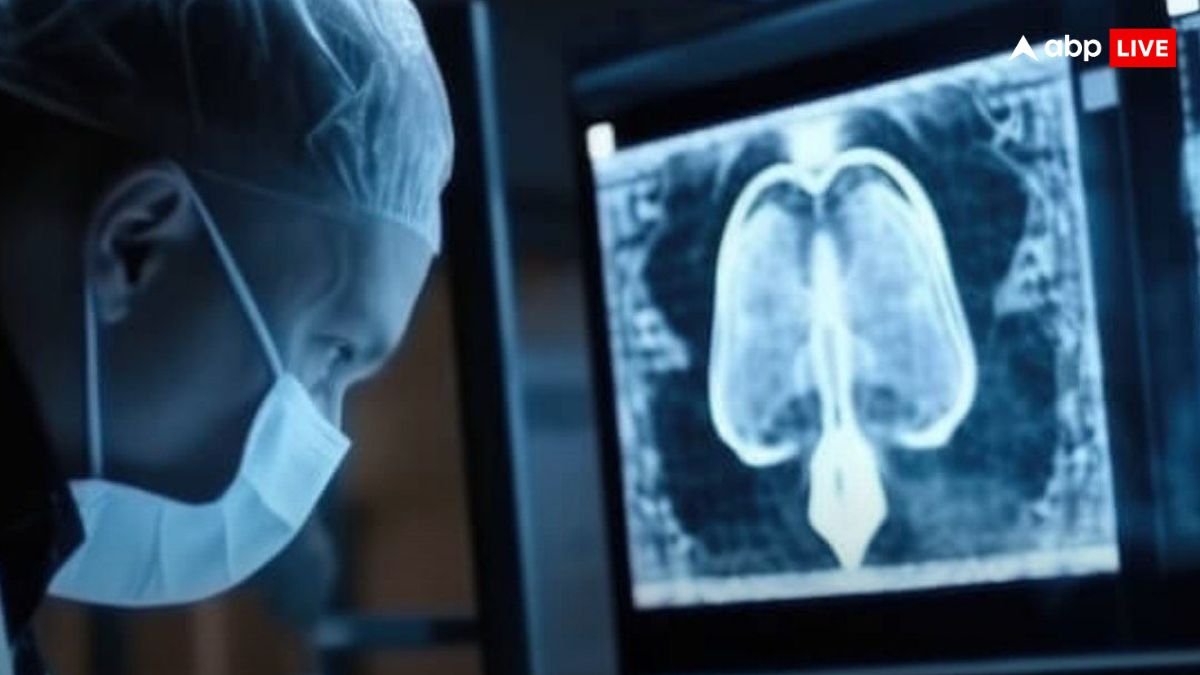 AI ने 5 मिलियन लोगों में फेफड़े के कैंसर का पता लगाया, अब समय पर इलाज संभव