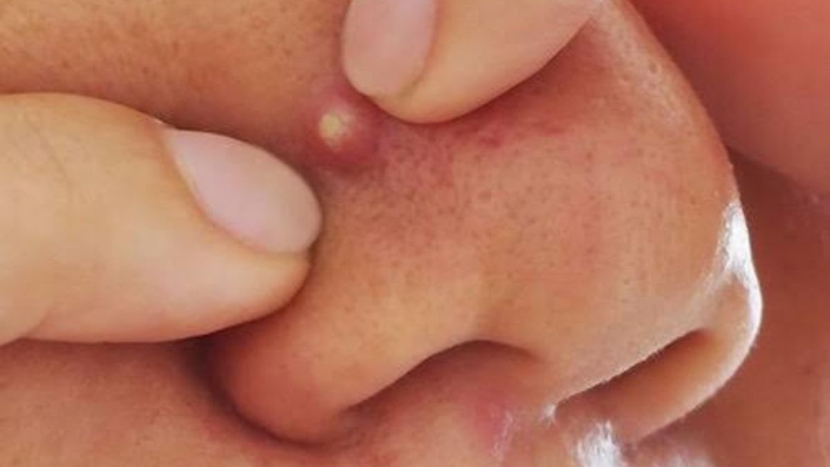 इस जगह पर कभी न फोड़े पिंपल... ट्रायंगल ऑफ डेथ ले सकता है आपकी जान