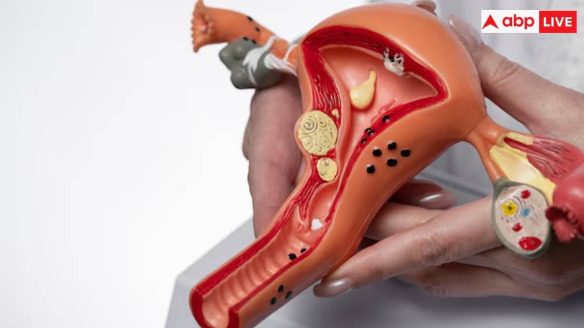 एंडोमेट्रियोसिस क्या है? किस उम्र में महिलाओं को इस बीमारी का रहता है खतरा