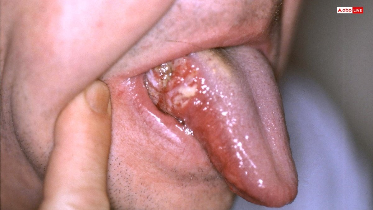 मुंह में दिख रहे हैं ये निशान, तो समझ लीजिए हो गया है कैंसर