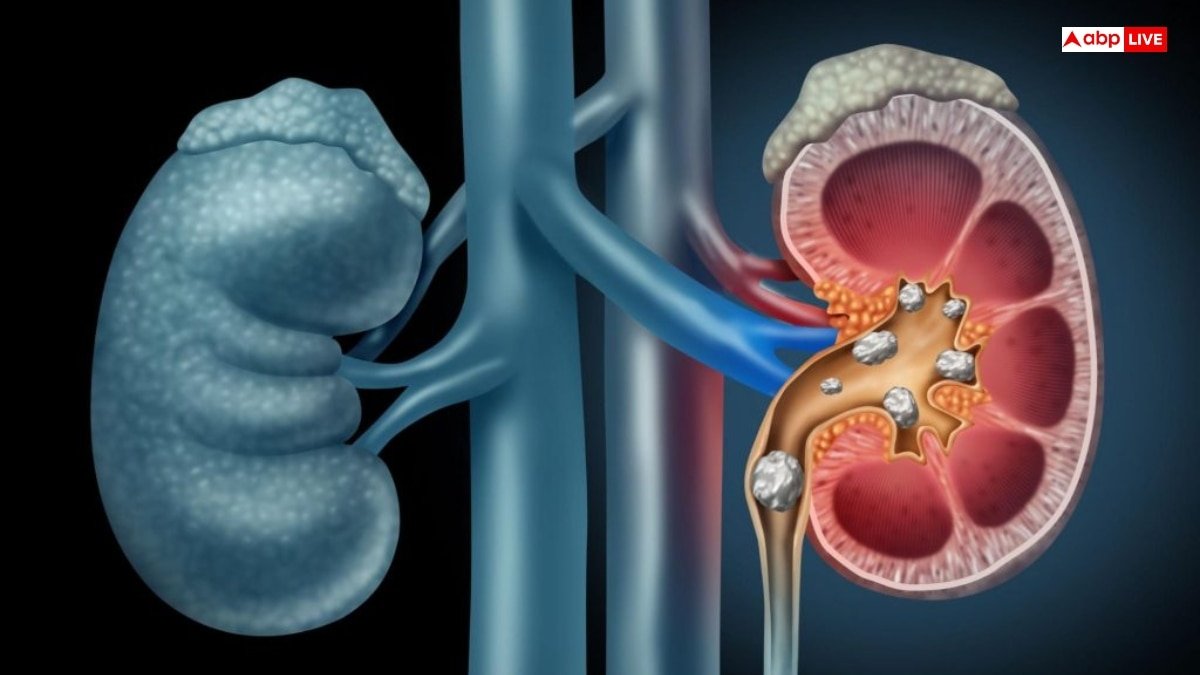 पथरी के मरीजों को खिलाई जाती है ये वाली दाल, फायदे जानकर हैरान रह जाएंगे आप