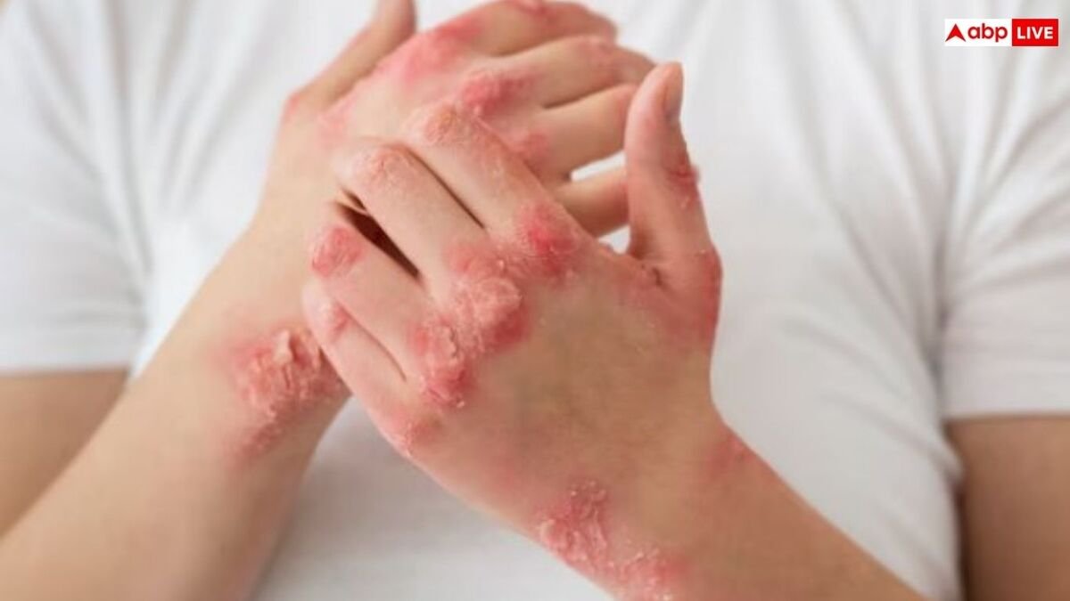 स्किन पर भी होता है फंगल इन्फेक्शन, जानिए इसे कम करने के आसान से उपाय