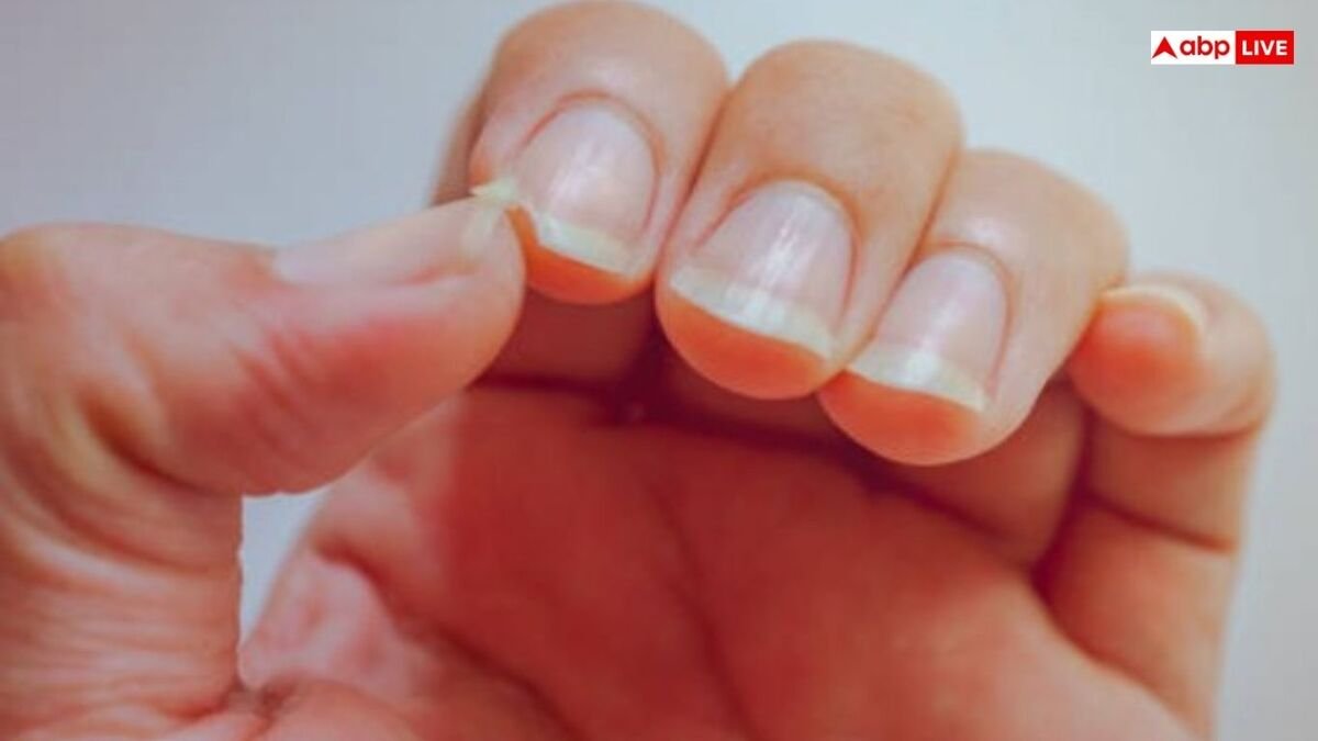 Nail Marks Symptoms: नाखून के ऊपर दिख रहा है ये निशान तो समझ लीजिए इस चीज की हो गई कमी, कई इशारे करते हैं हमारे नाखून