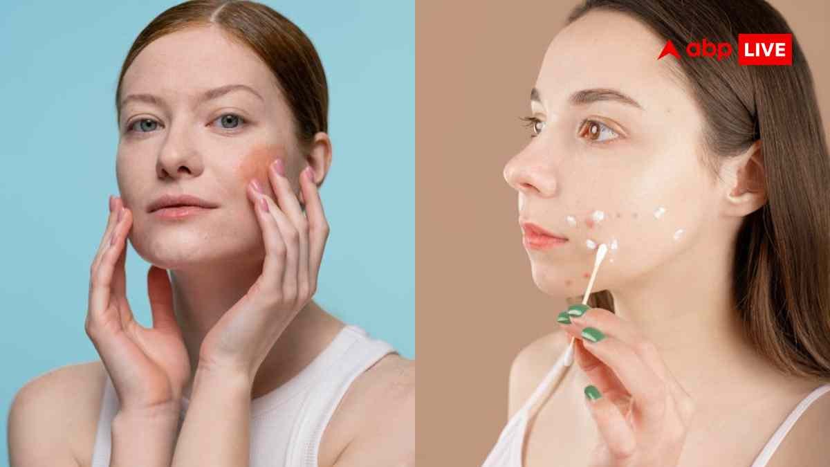 क्या लाइलाज है सोरायसिस की बीमारी, इसके मरीजों को किन बातों का रखना चाहिए ध्यान